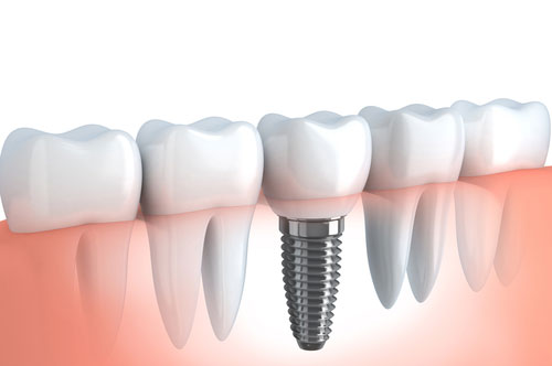 dental implants in new delhi, india