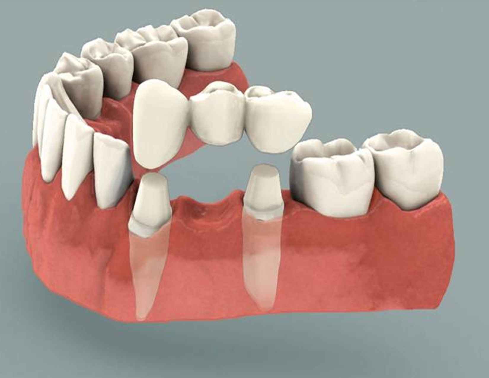 dental bridges in new delhi