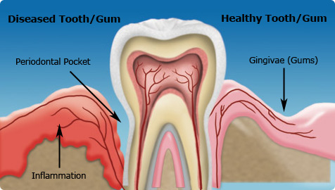 gum disease treatment new delhi